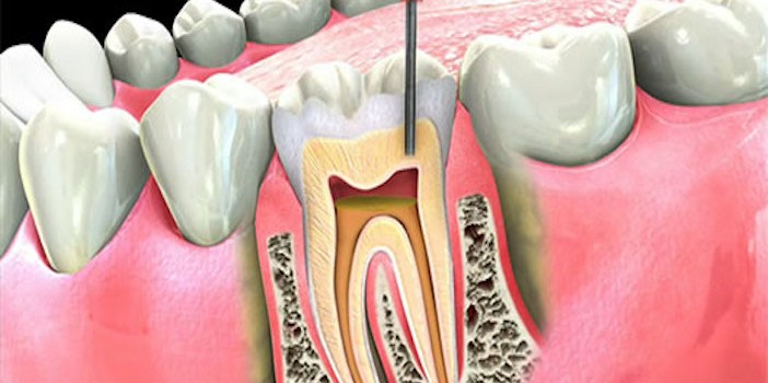 teeth_implant