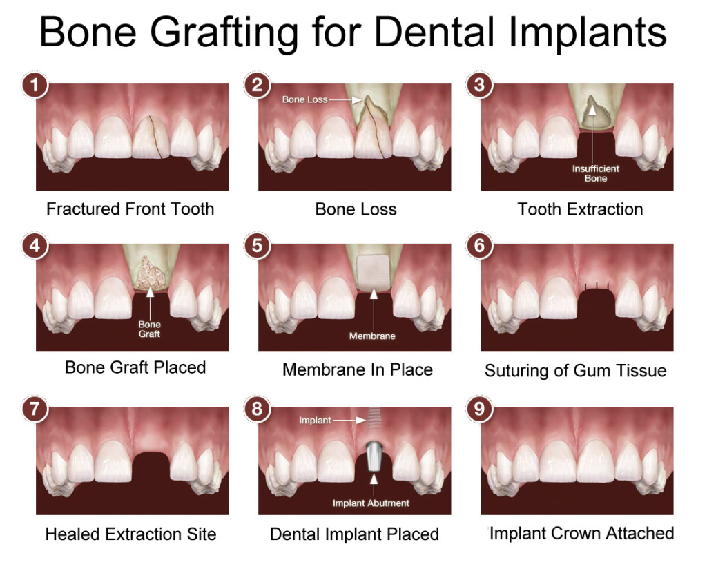 Dental Pain