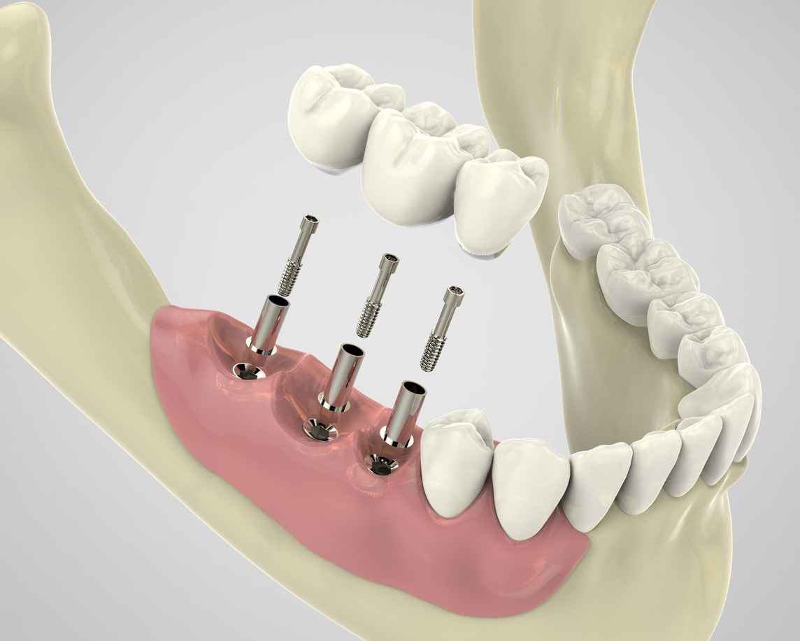 teeth_replace