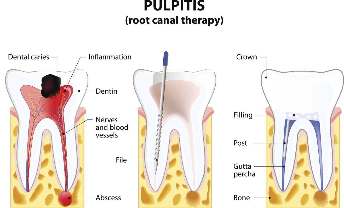 Dental Pain