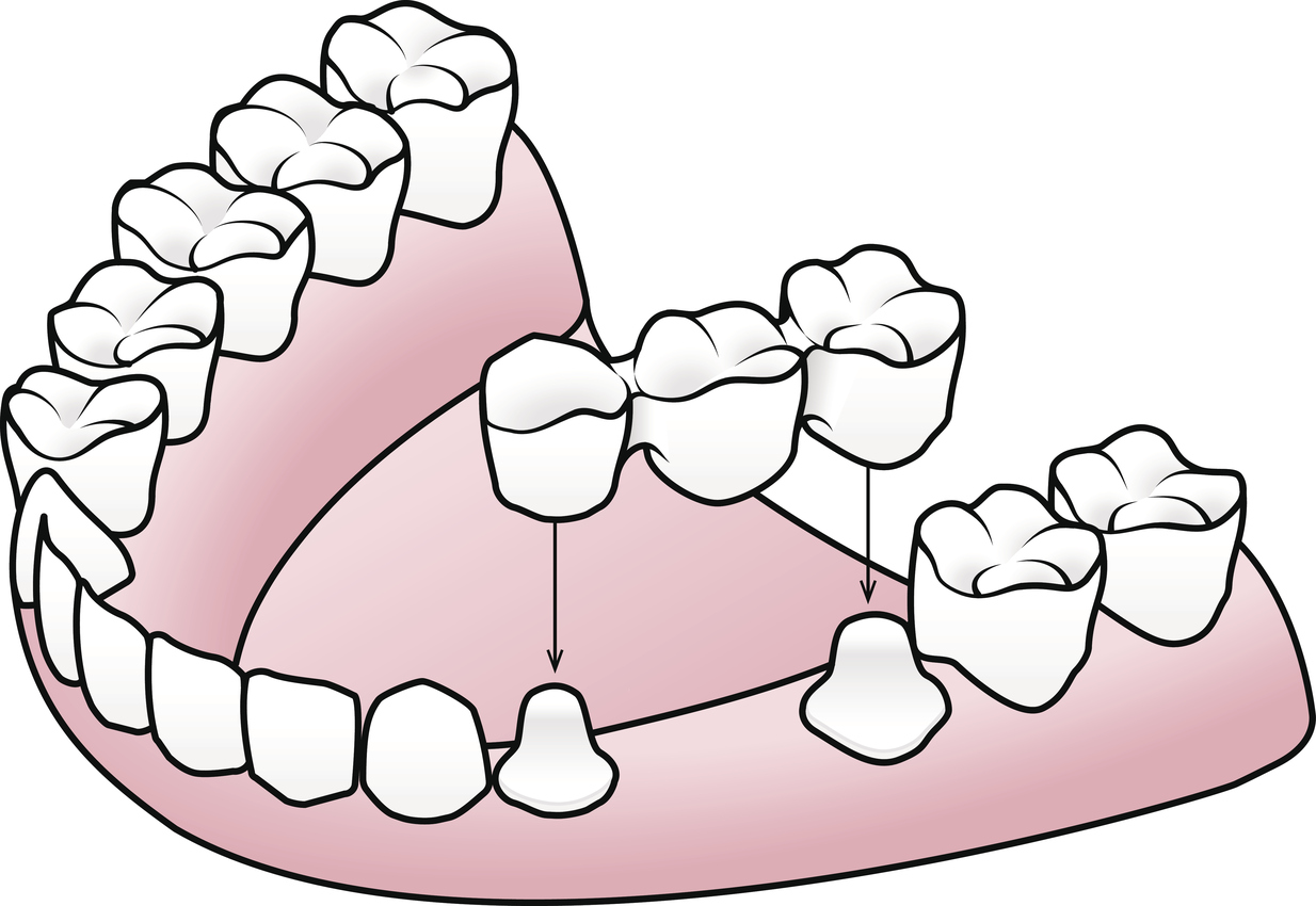 Dental Restoration