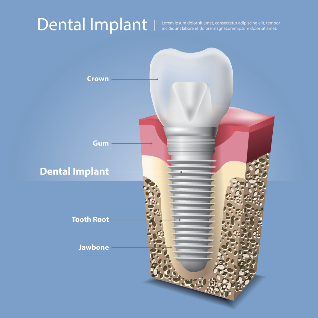 Dental Pain