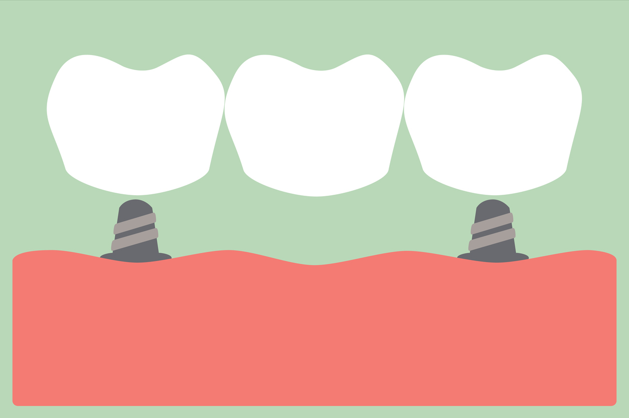 Dental Implant Springvale