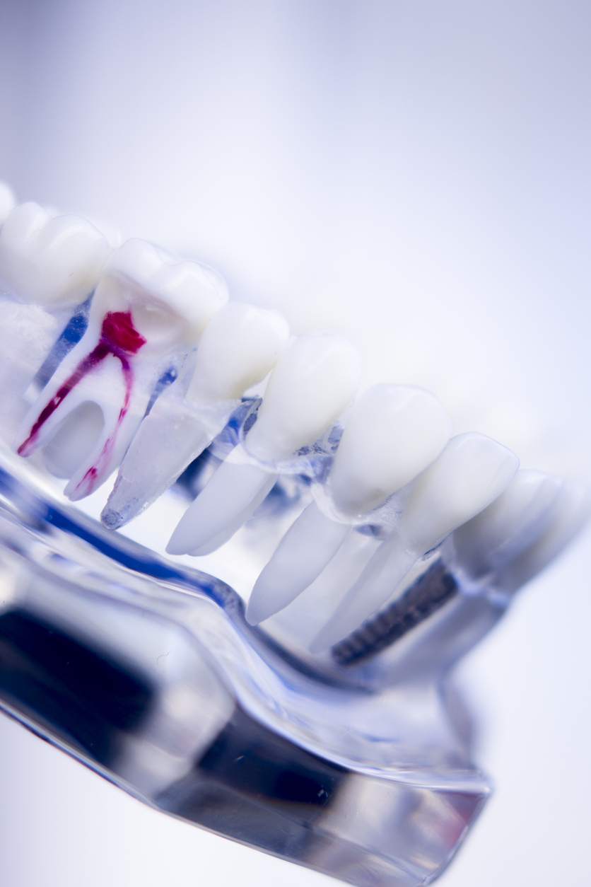 Dentists tooth plastic model with screw implant for teaching, learning and patients in dental office showing teeth and gums.