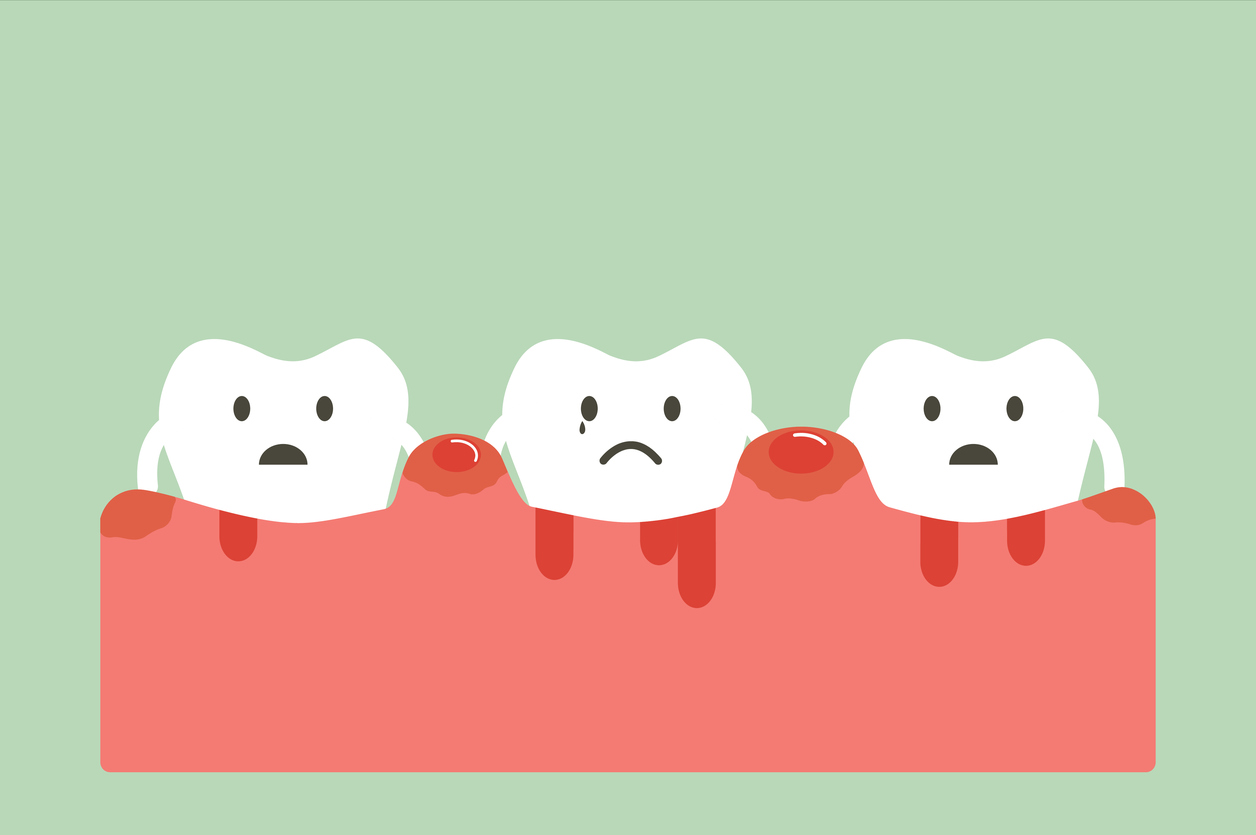 Gum Dieases