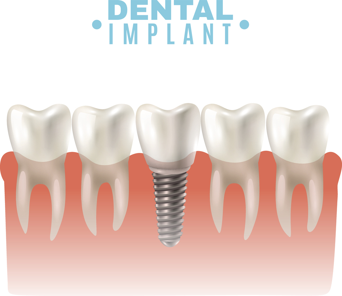 dental_implants