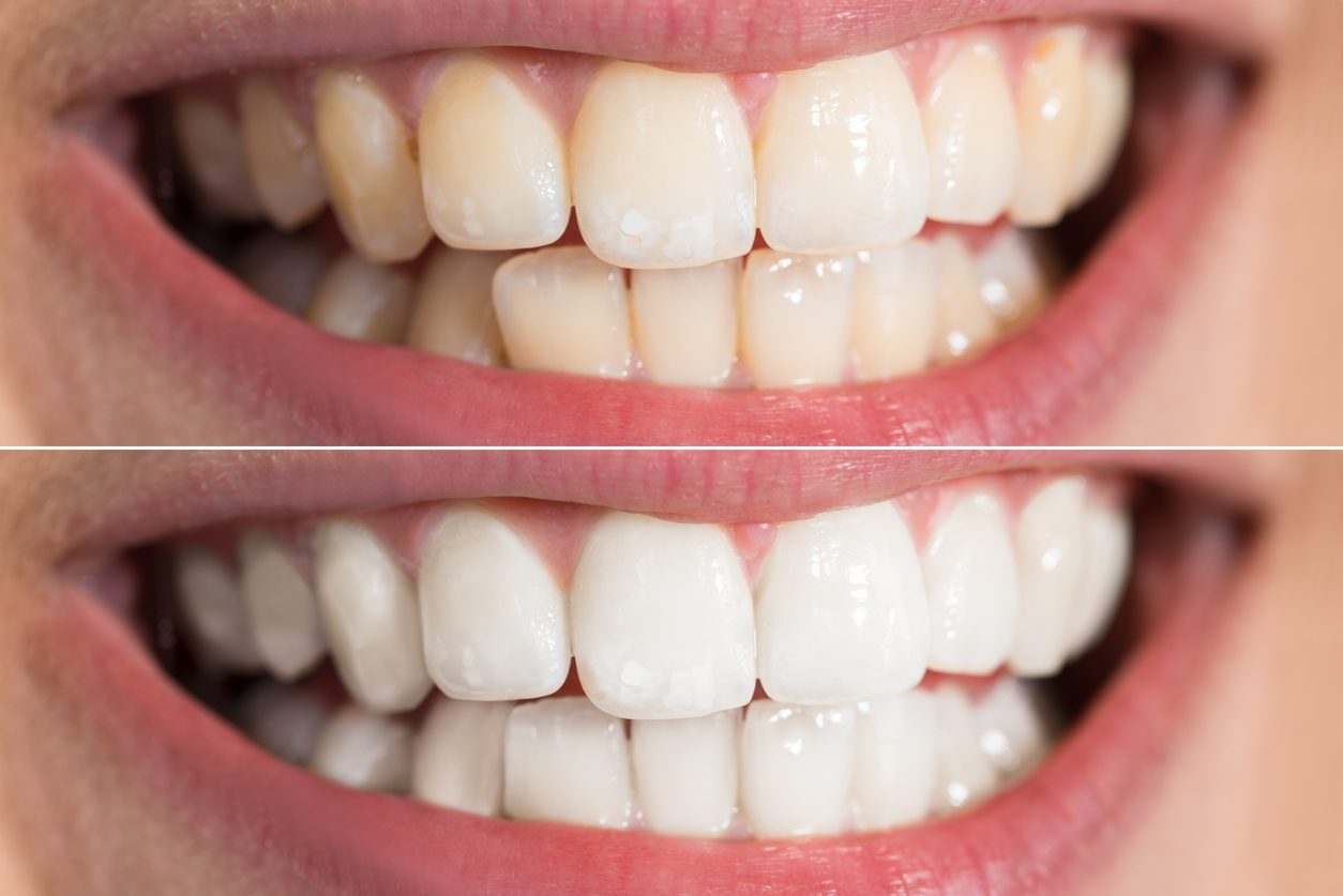 Person Teeth Before And After Whitening