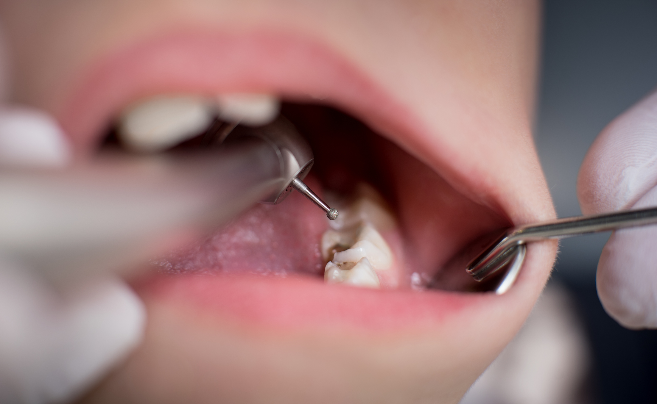 dental cavities