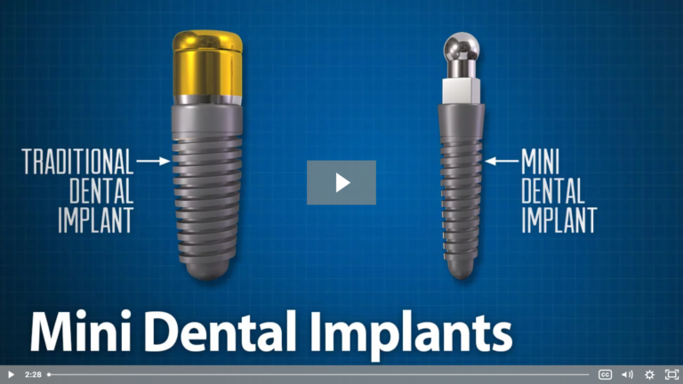 Dental Implants: Traditional VS. Mini Dental Implants