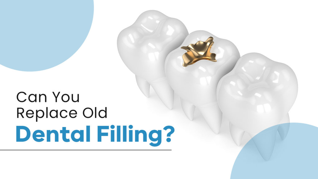 Can You Replace Old Dental Filling? Here's What You Should Know