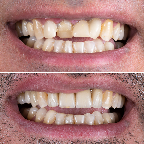 Veneers before and after